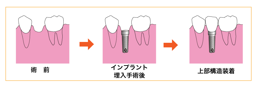 インプラント術前術後イメージ