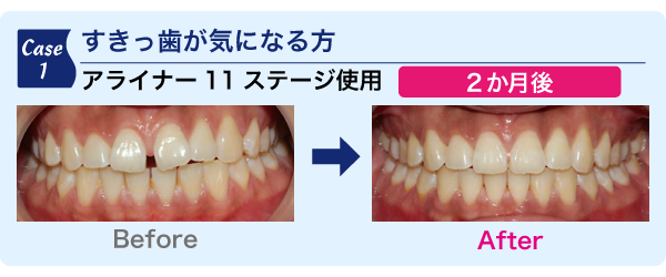 すきっ歯が気になる方