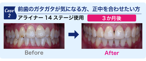 前歯のガタガタが気になる方、正中を合わせたい方