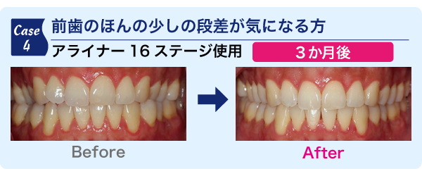 前歯のほんの少し段差が気になる方
