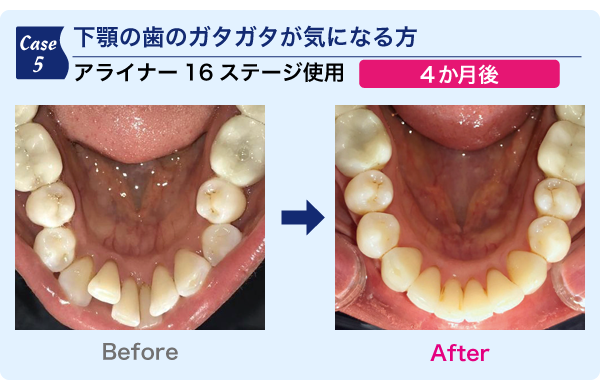 下顎の歯のガタガタが気になる方