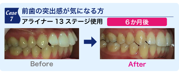 前歯の突出感が気になる方