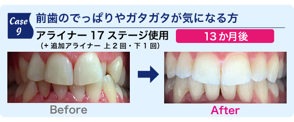 前歯のでっぱりやガタガタが気になる方