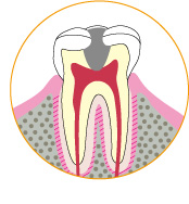 虫歯のイメージ図