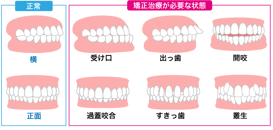 矯正治療が必要な状態